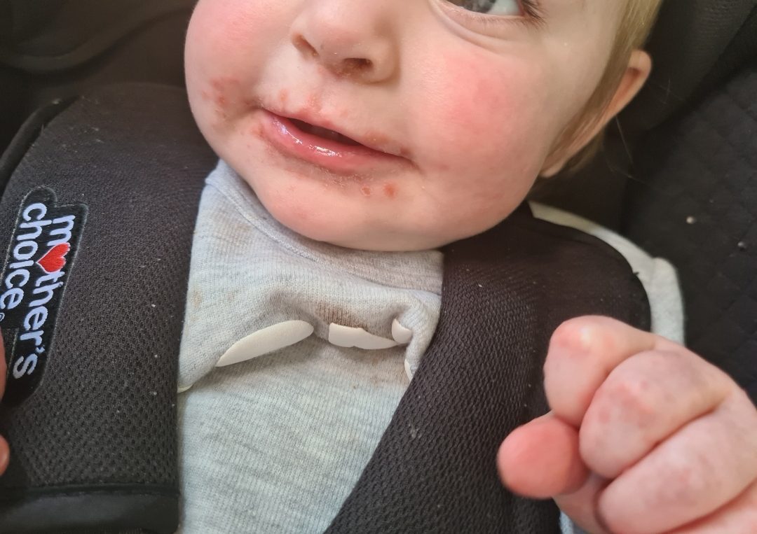 baby sitting in car seat with a close up of clenched fist and face - around the mouth area there are red sore spots